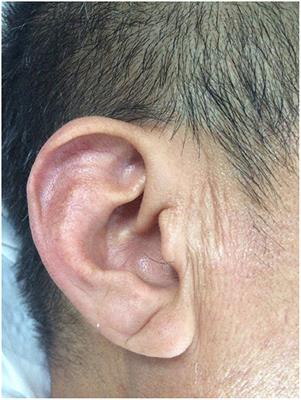 Adropin and Irisin Deficiencies Are Associated With Presence of Diagonal Earlobe Crease in CAD Patients